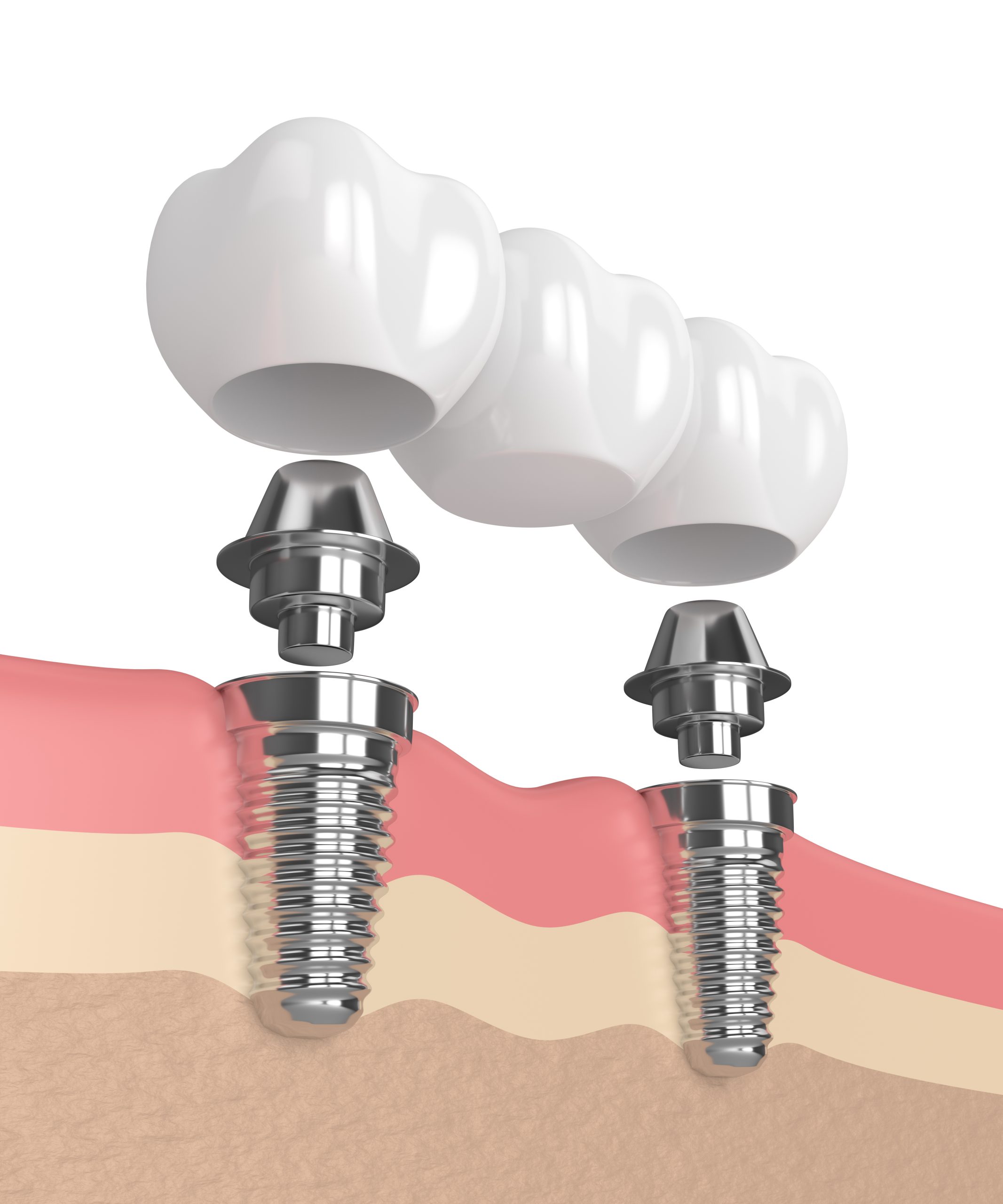 Treating Your Tooth Loss With A Custom Bridge | Rowlett, TX