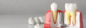 rowlett dental implants
