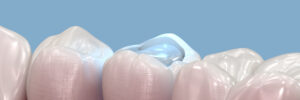 rowlett dental fillings