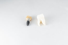 Navigating Dental Implant Placement With Digital Tech