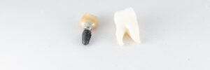 rowlett dental implants